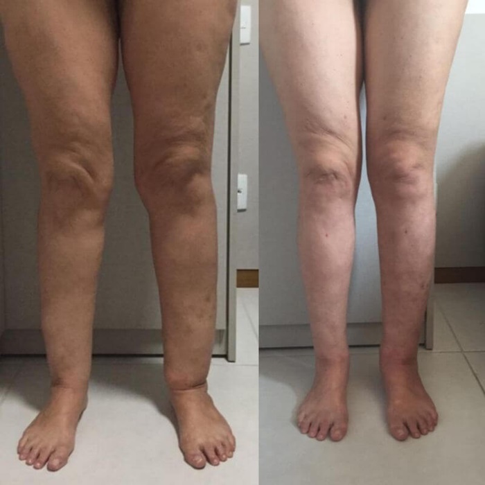lipedema-antes-e-depois01.jpg